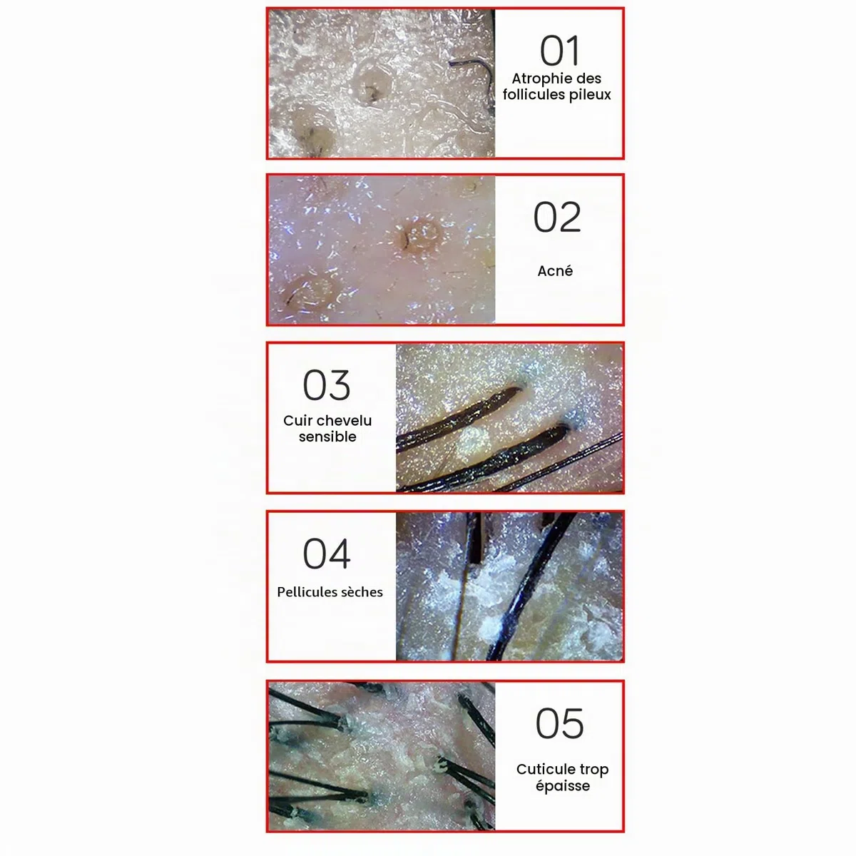 Analyseur de Cheveux de Diagnostic de Peau, 15,6 Pouces 50X 200X Détecteur de Cuir chevelu de Cheveux de Peau Microscope de Cuir chevelu Analyseur de Cuir chevelu de Peau de follicule pileux(EU)